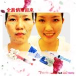 2of5-Shaping & Lightening-全脸俏丽起来-散散-大优惠-3D1&3Dplus&AH